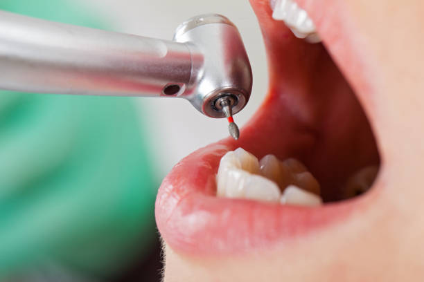 Best Emergency Tooth Extraction in Nolensville, TN